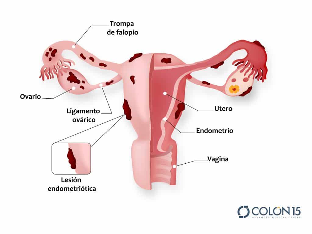 que es endometriosis colon sevilla