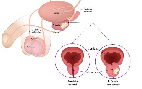 prostata4